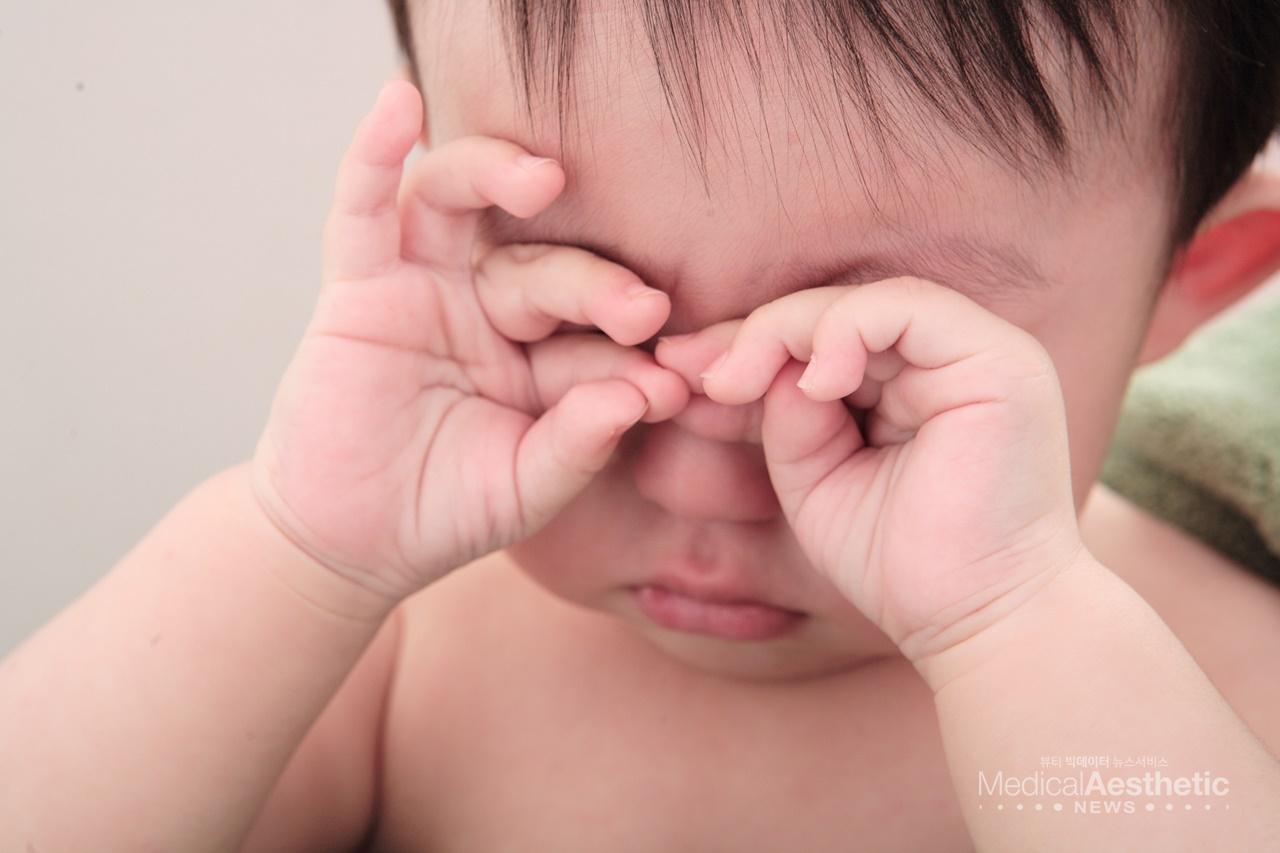 혈관종은 대부분 12개월부터 퇴행기를 지나면서 자연스럽게 사라지지만 증상이 사라지지 않고 계속 남으면 여러 가지 문제를 일으킬 수도 있다. 눈 주위에 있는 혈관종은 커지면서 아기의 눈을 가릴 수 있고, 그 기간이 길어지면 시력을 잃게 되거나 난시가 발생할 수 있다. (본 이미지는 기사 내용과 관련 없음)