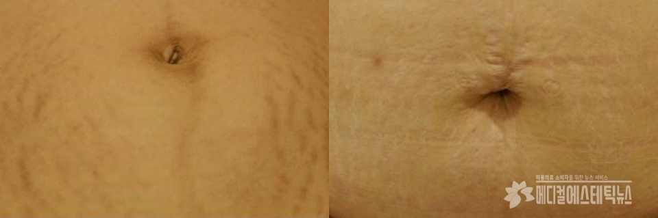 Stretch marks are caused by tearing of the dermis when the skin cannot withstand of pulling force from the sides or up and down.(Photo courtesy of Dr.Hyuna Kim, Owner of Mokdong DongAn Clinic)