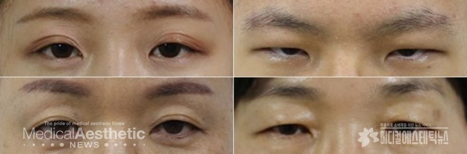 Various types of blepharoptosisCourtesy by Dr. Dongjun Yang, founder of Cheongdam U Beauty Medical CenterThere is ptosis, the upper eyelids cover the pupils, and in severe cases, the pupils are blocked, limiting the field of view. When the eyes are opened, if the pupils are covered by more than 2mm, it is considered ptosis.