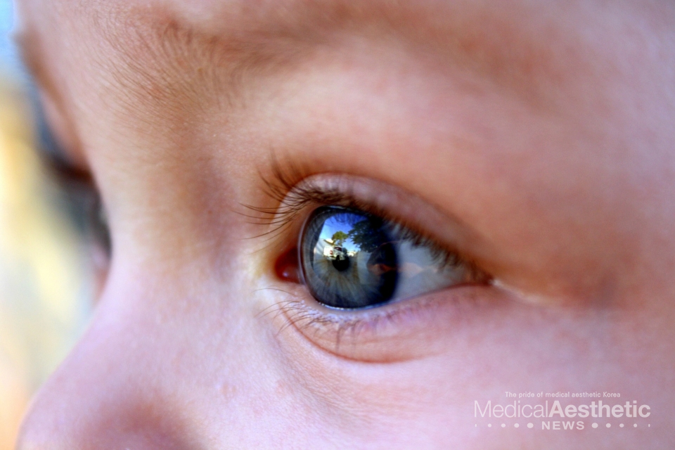 Congenital ptosis can cause myopia and astigmatism because the upper eyelid blocks the pupil from a young age, preventing the retina from focusing properly, and it can interfere with vision and lead to amblyopia. (This image is not related to the content of the article)